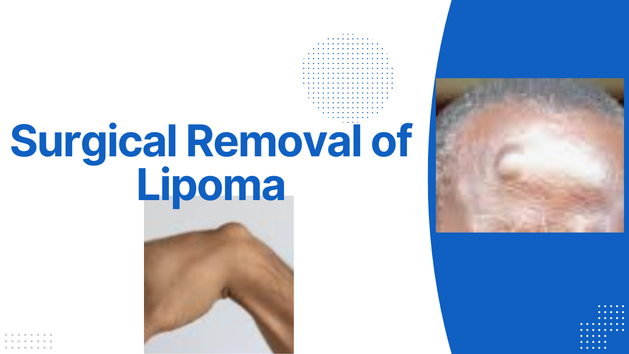 Read more about the article Lipoma Removal Surgery: What You Need to Know